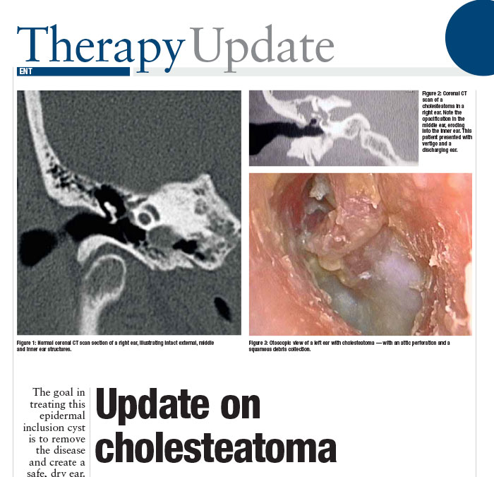 Cholesteatoma Surgery Cholesteatoma Surgery