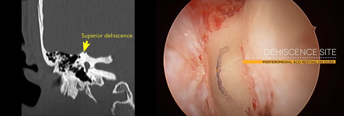 Superior Canal Dehiscence Syndrome